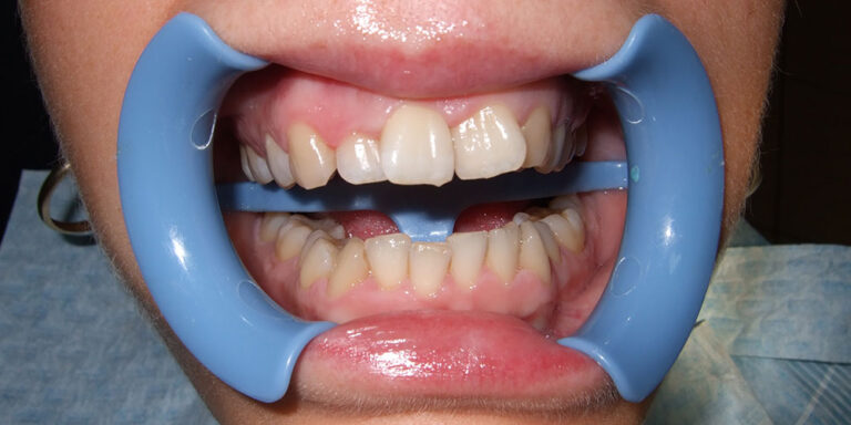 Metamorfoza 2 - przed