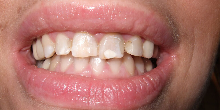 Metamorfoza 3 - przed