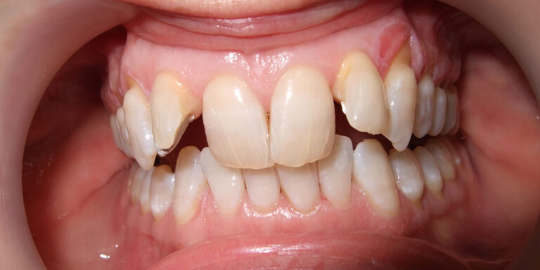 Metamorfoza 4 - przed