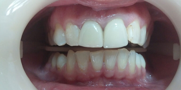 Metamorfoza 9 - przed