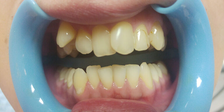 Metamorfoza 10 - przed